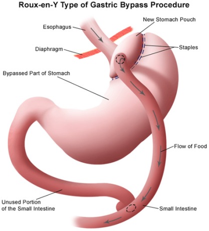 Some people may look to gastric bypass surgery as a solution as dieting and 